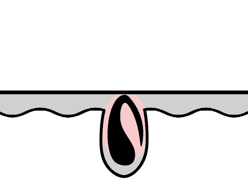 Eingewachsenes Haar Variante 3